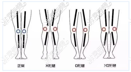 不同腿型展示对比