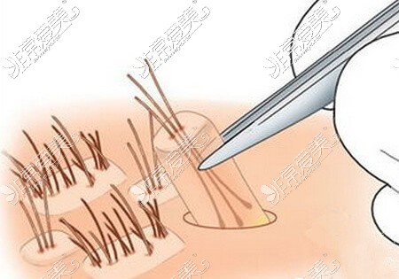 植發(fā)毛囊提取卡通圖