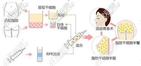 水动力吸脂示意图