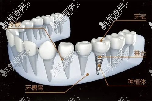 私人牙科诊所种植牙靠谱吗