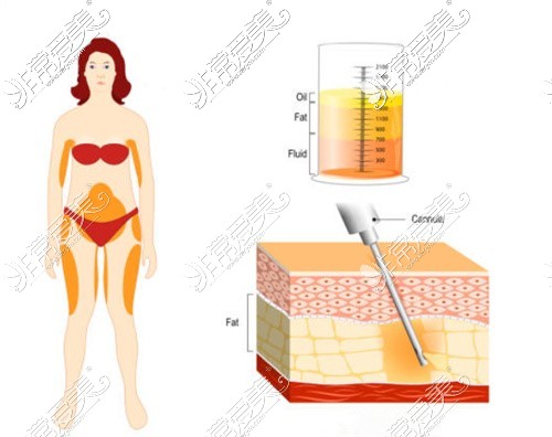 成都缩胸手术—般多少钱?成都巨乳缩小3-10W元您适合哪种?