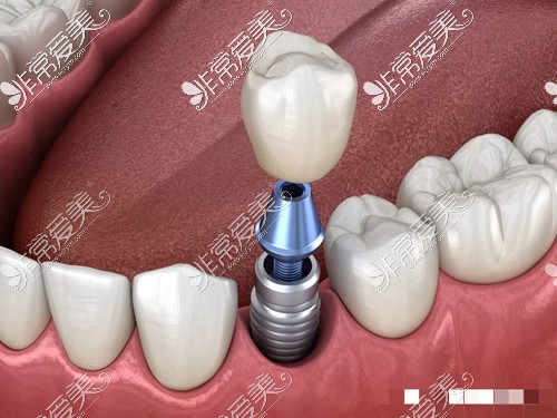种植牙图示