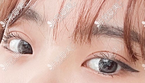 韩国双眼皮整形14天照片