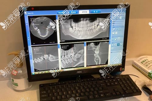 深圳友诚齿科牙齿治疗术前CT拍摄