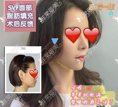 西安画美医院SVF脂肪胶填充技术