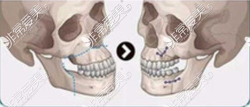 双颌正颌手术图示
