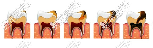牙髓炎的发展过程