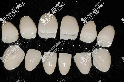 牙齿瓷贴面材料图示