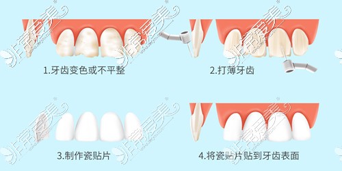 牙齿瓷贴面修复过程卡通图
