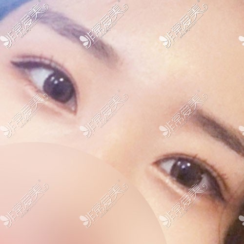 韩国yellow双眼皮术后60天照片
