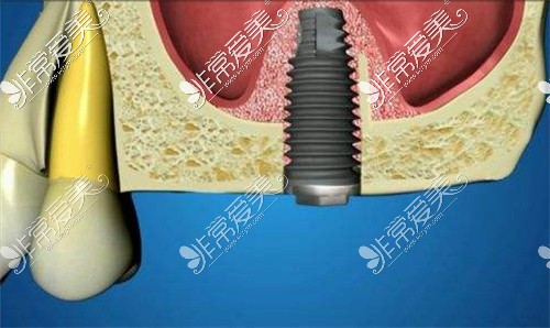 泸州种植牙上颌窦内提升术示意图
