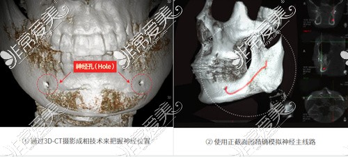 成都削骨CT图