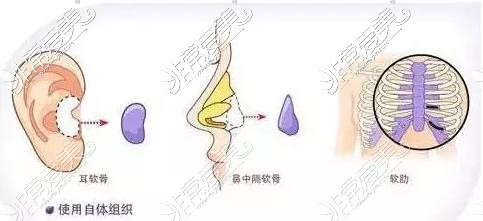 軟骨隆鼻示意圖