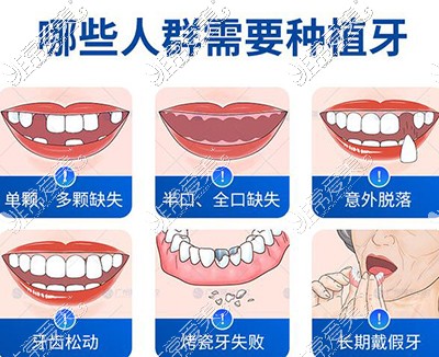 哪些牙齿需要做种植牙修复