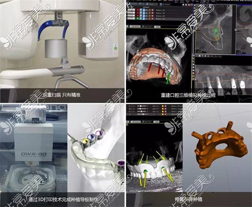 达州达康口腔数字化种植牙示意图