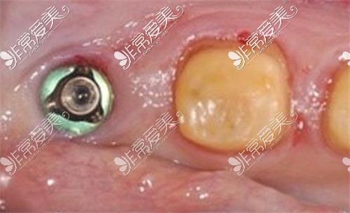达州种植牙修复基台图