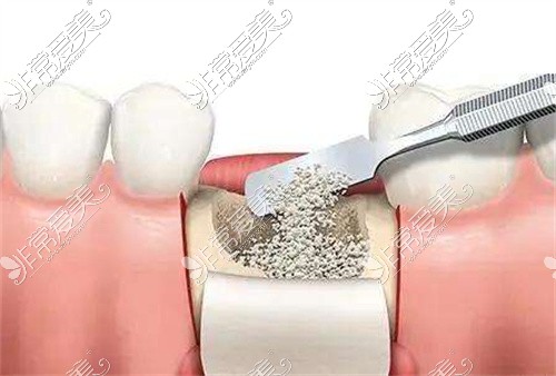 达州种植牙骨粉图