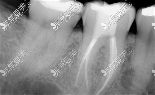 根管治疗后拍片