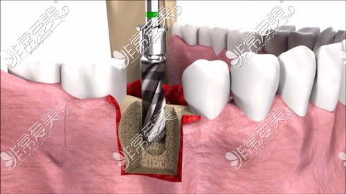 种植牙修复缺牙方式图示