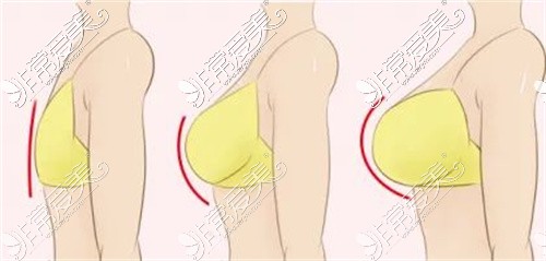 四川娇点整容医院隆胸卡通示意图