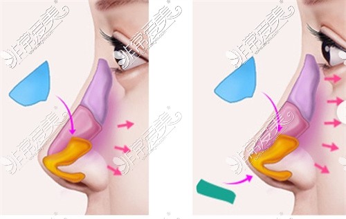 四川嬌點整容醫(yī)院鼻部整形示意圖