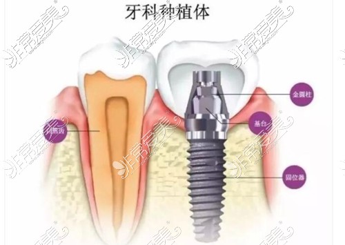 牙科种植牙各部位图示
