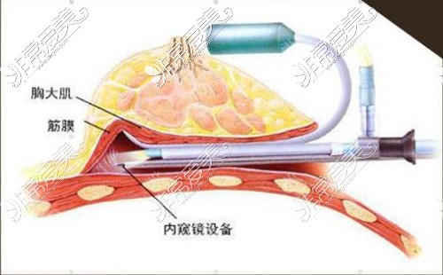 內窺鏡隆胸圖示