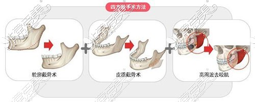 四方脸瘦脸手术示意图