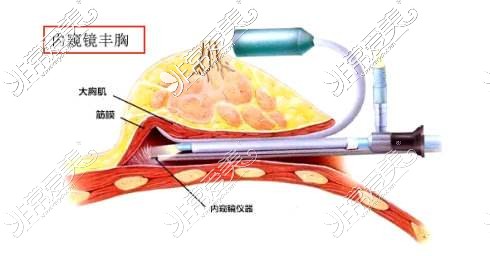 內(nèi)窺鏡隆胸圖示