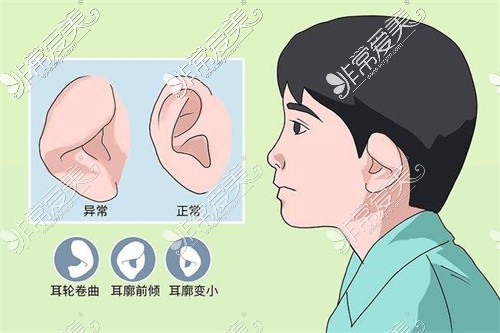 成都小耳畸形再造手术卡通图