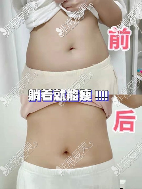 韩国美尔韩方瘦腰过程图