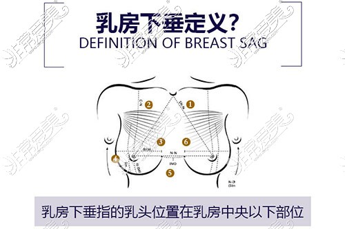 乳房下垂示意图