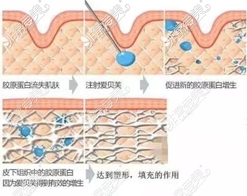 愛貝芙改善作用示意圖分析