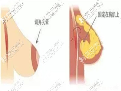 乳房悬吊术下垂矫正过程