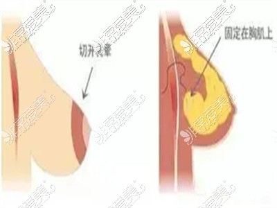 乳房懸吊術下垂矯正過程