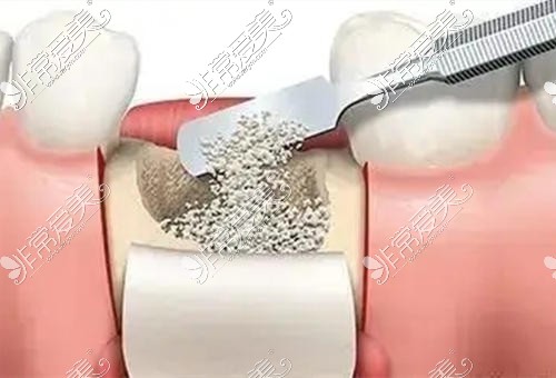 种植牙植骨粉23天后出现意外,果然这就是种植牙失败的前兆