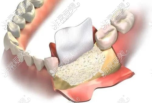 牙槽骨萎缩植骨粉