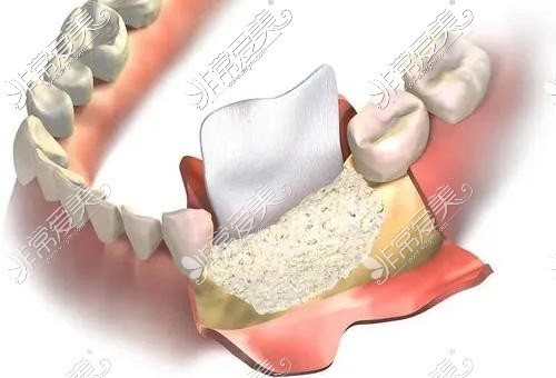 牙槽骨萎縮植骨粉