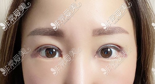 韩国yellow双眼皮术后14天照片