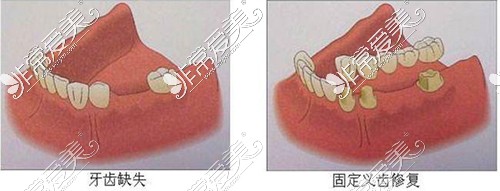 牙齿缺失固定义齿修复