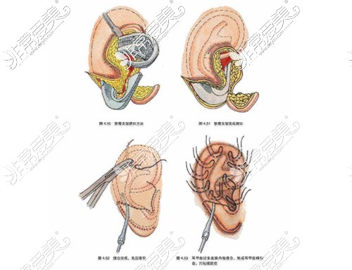小耳畸形直埋术法手术过程