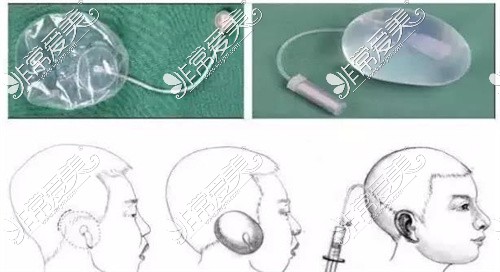 小耳畸形全包手术方法图