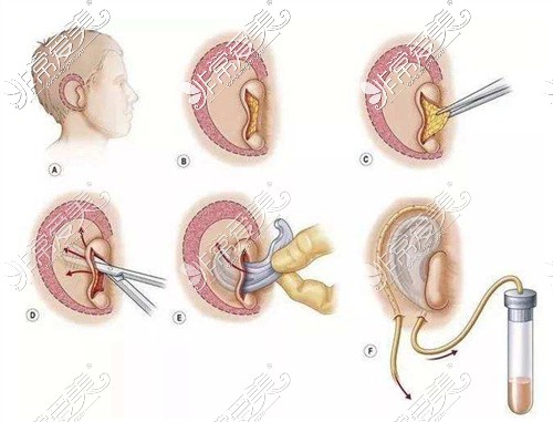 小耳畸形全包手术方法示意图
