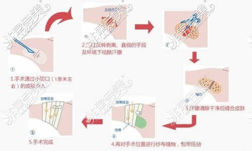 做腋臭手術(shù)流程分析