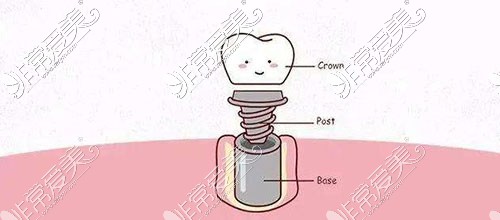种植牙示意图