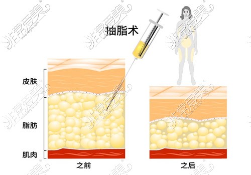 吸脂手术前后脂肪的变化