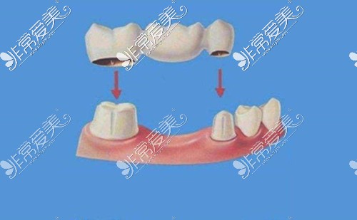 什么是搭桥假牙？搭桥假牙示意图