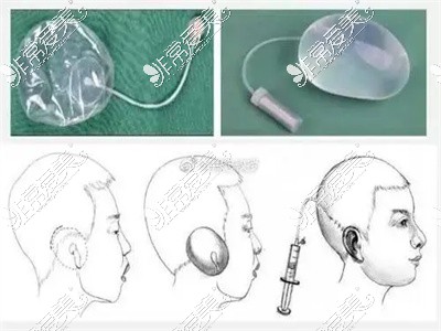 皮肤扩张全耳再造手术步骤