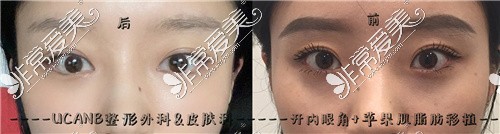 韩国UCANB整形外科开眼角+苹果肌脂肪移植前后对比