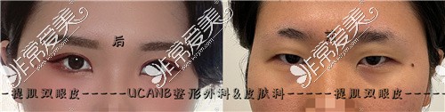 韩国UCANB整形外科提肌双眼皮前后对比